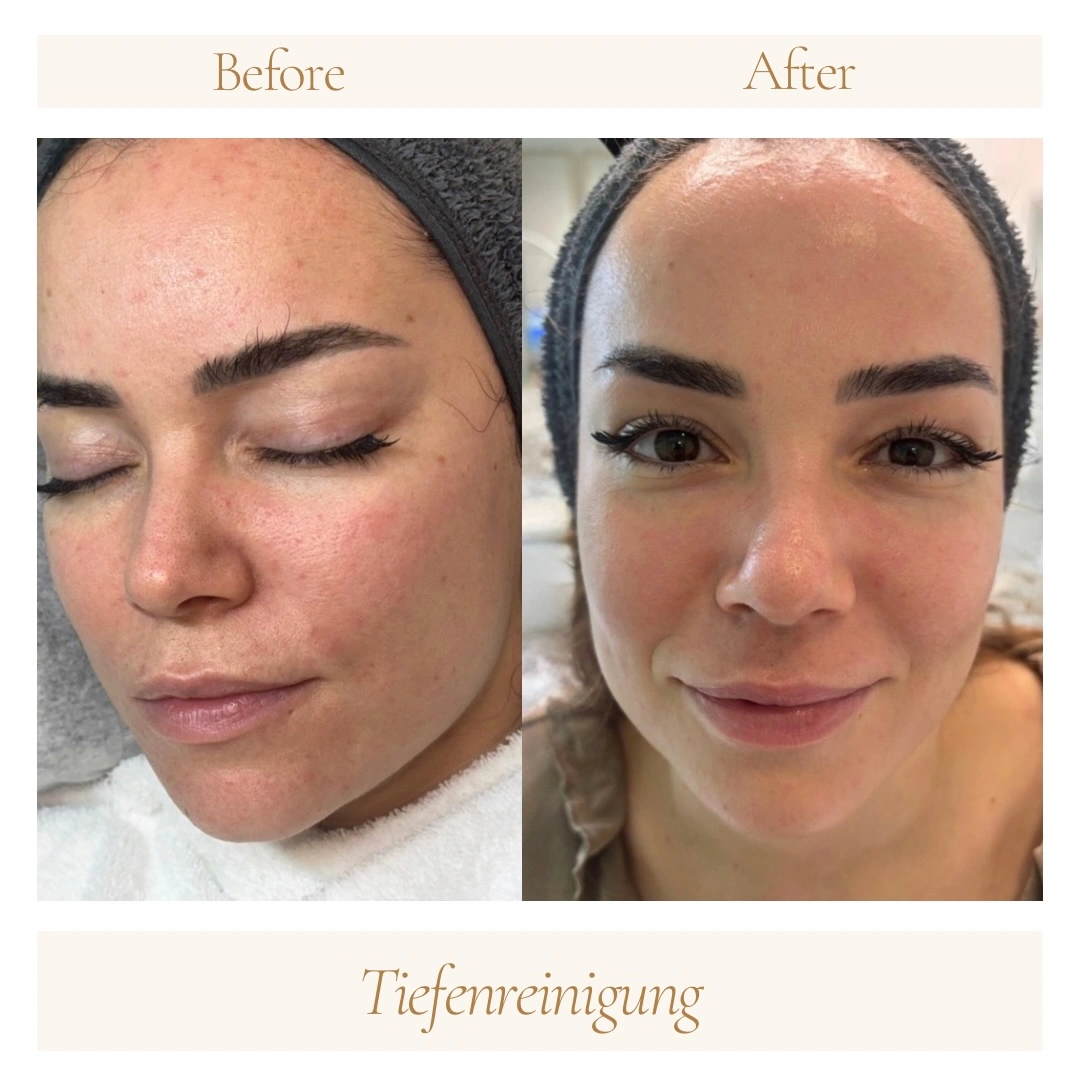 Vorher-Nachher-Ergebnis einer Aqua Facial Tiefenreinigung im Kosmetikstudio Ginié in Heidelberg.