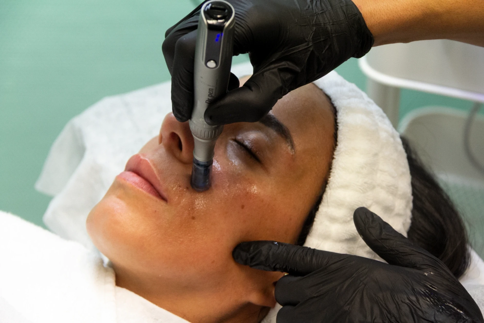 Needling mit Hyaluron Behandlung im Kosmetikstudio Ginie in Heidelberg.